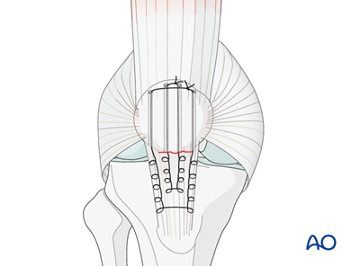 Ligament Fixation step 1